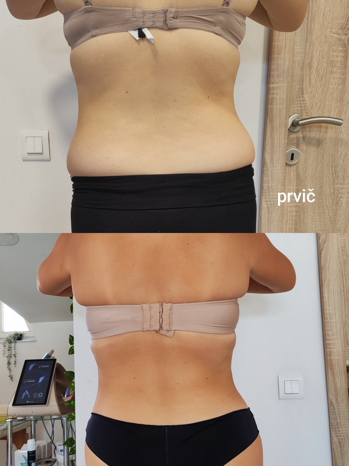 Kombinacije HIFU in Velashape