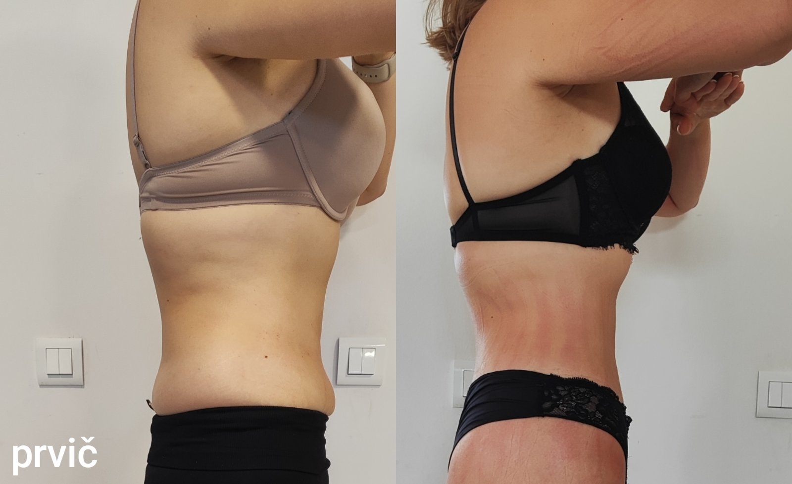 Kombinacije HIFU in Velashape Kombinacije HIFU in Velashape
